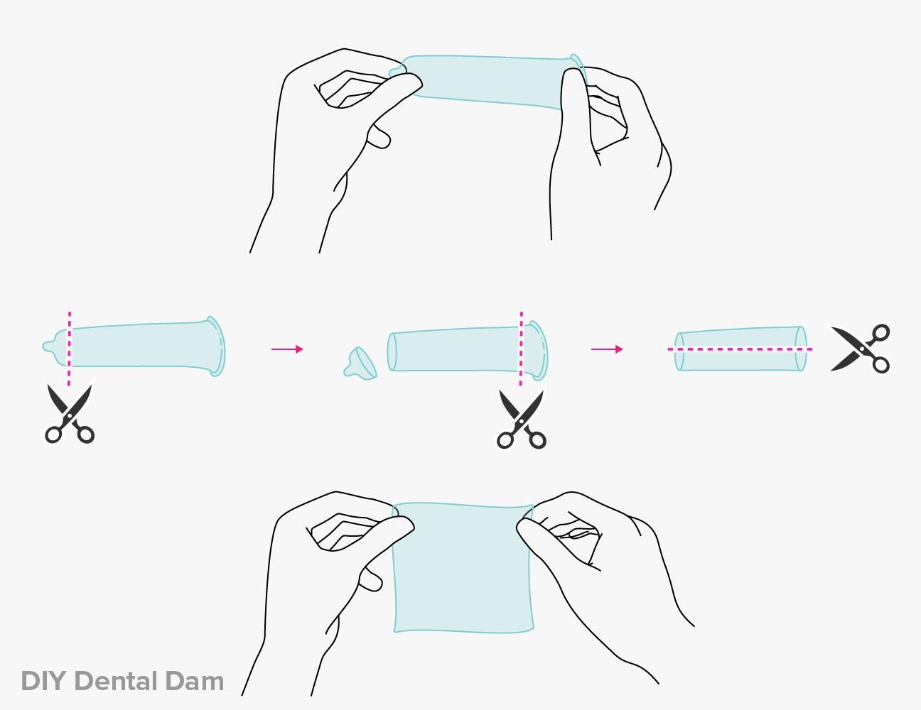DIY dental dam from condom